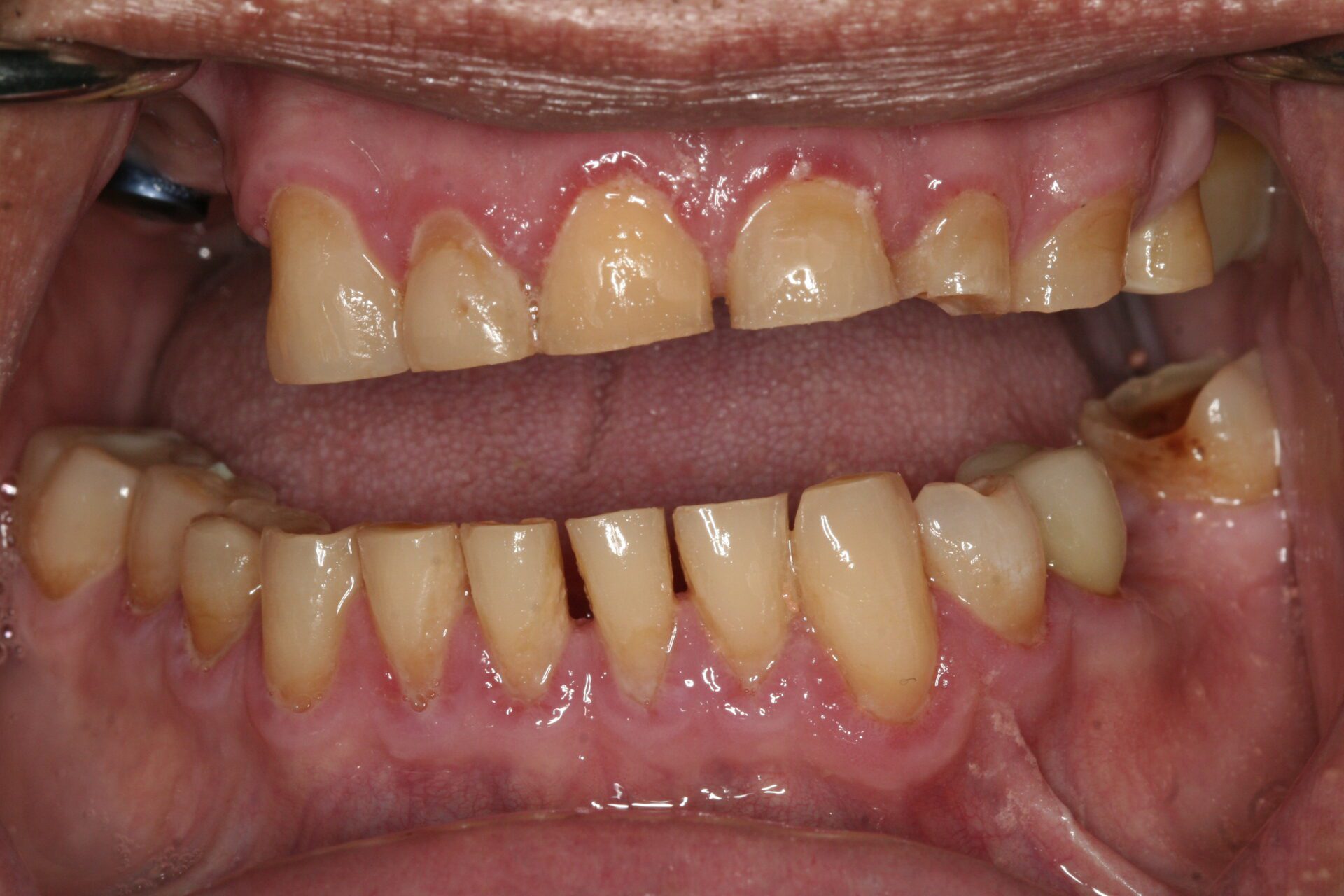 Oral Rehabilitation Case 3